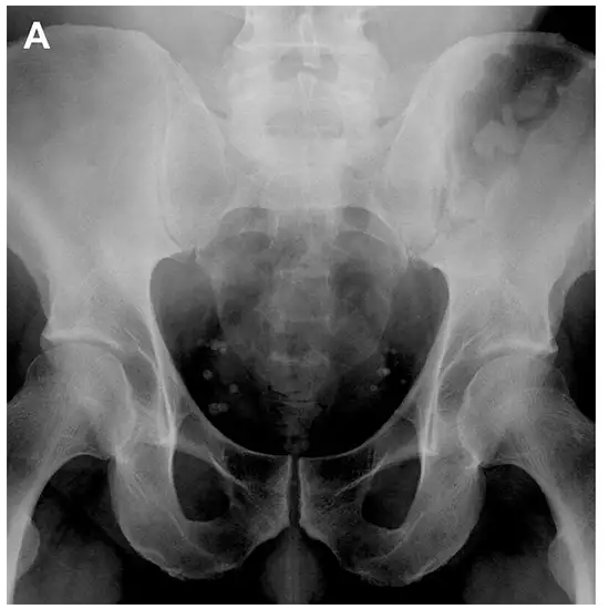 X-Ray Right SI Joint AP Oblique